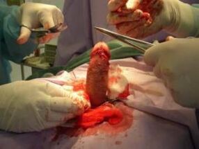cirugía de agrandamiento del pene